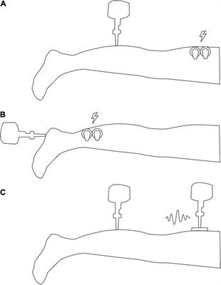 Remote Subthreshold Stimulation Enhances Skin Sensitivity in the Lower Extremity